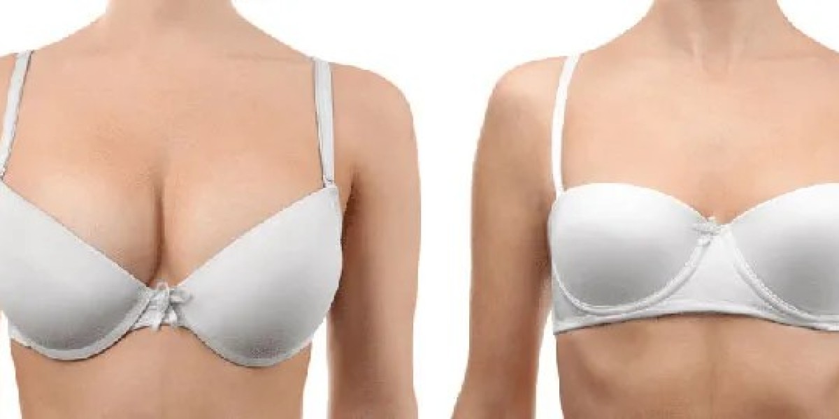 Importance of Realistic Expectations in Breast Reduction