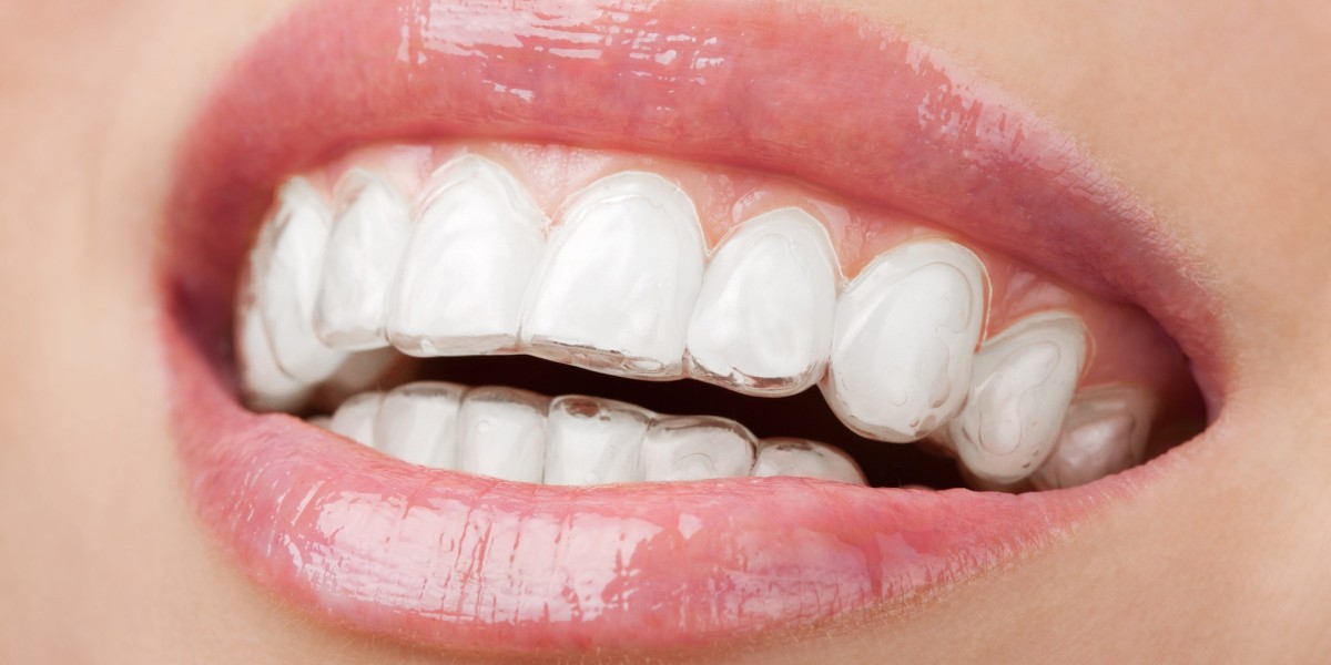 Smile Confidently: Enhancing Your Smile with Invisalign Aligners at Amma Naana Dental Clinic